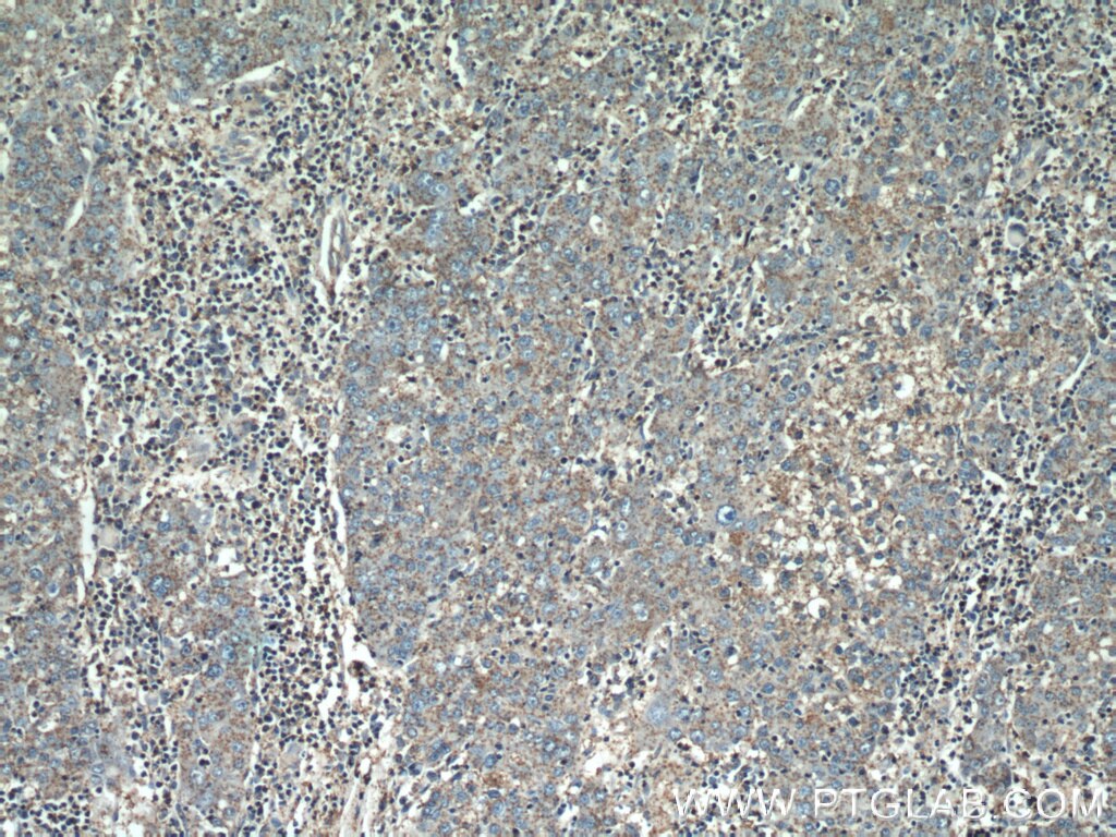 Immunohistochemistry (IHC) staining of human liver cancer tissue using Alpha Tubulin Polyclonal antibody (11224-1-AP)