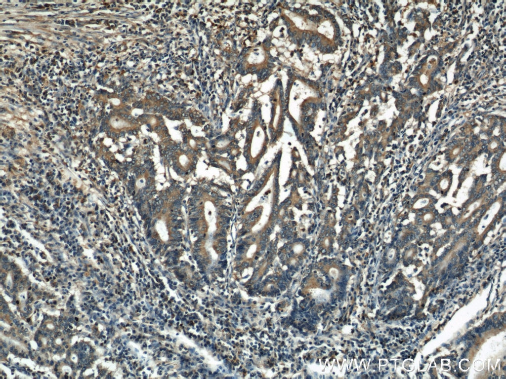 Immunohistochemistry (IHC) staining of human endometrial cancer tissue using Alpha Tubulin Polyclonal antibody (11224-1-AP)