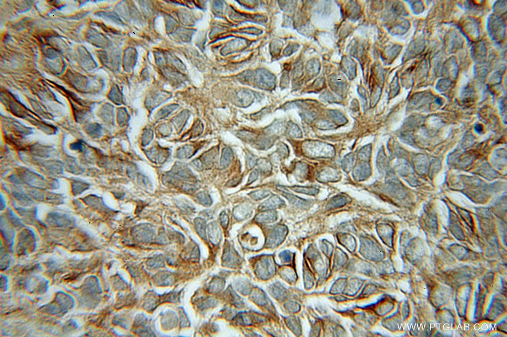 Immunohistochemistry (IHC) staining of human medulloblastoma tissue using Beta Tubulin Polyclonal antibody (10063-2-AP)