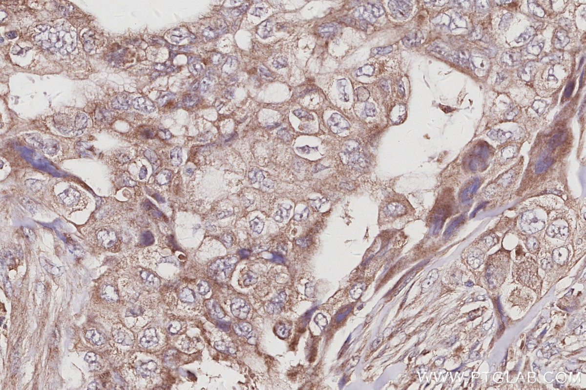 IHC staining of human pancreas cancer using 27433-1-AP Immunohistochemistry (IHC) staining of human pancreas cancer tissue using TUBD1 Polyclonal antibody (27433-1-AP)