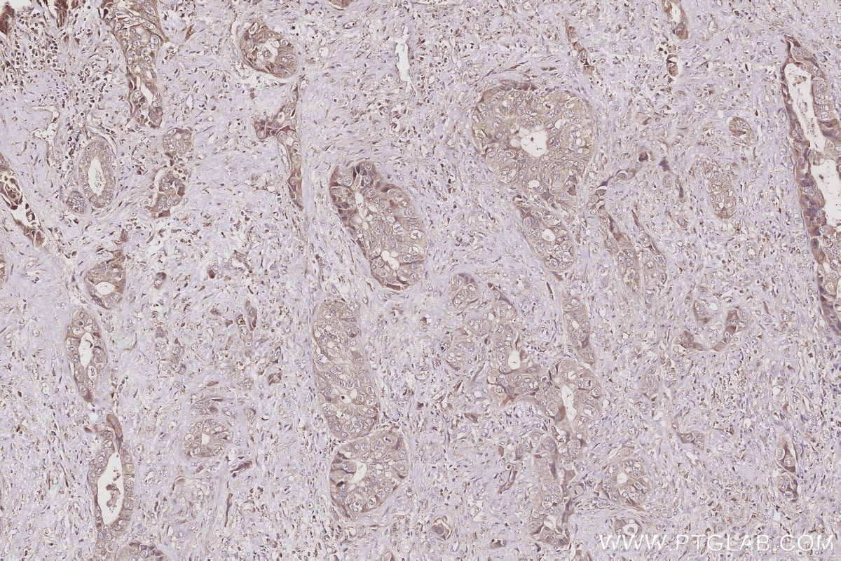 Immunohistochemistry (IHC) staining of human pancreas cancer tissue using TUBD1 Polyclonal antibody (27433-1-AP)