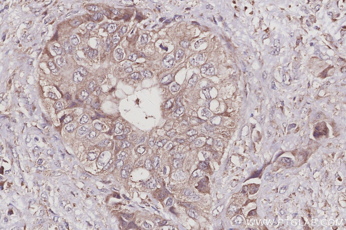 IHC staining of human pancreas cancer using 27433-1-AP Immunohistochemistry (IHC) staining of human pancreas cancer tissue using TUBD1 Polyclonal antibody (27433-1-AP)