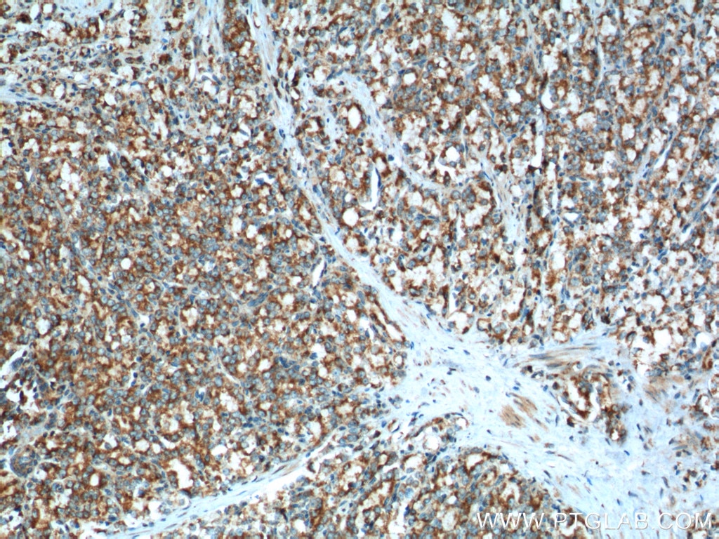 Immunohistochemistry (IHC) staining of human prostate cancer tissue using Gamma Tubulin Polyclonal antibody (15176-1-AP)