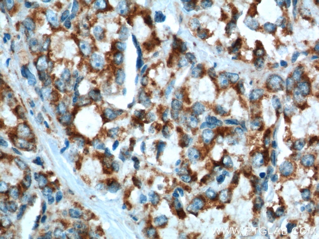 Immunohistochemistry (IHC) staining of human prostate cancer tissue using Gamma Tubulin Polyclonal antibody (15176-1-AP)