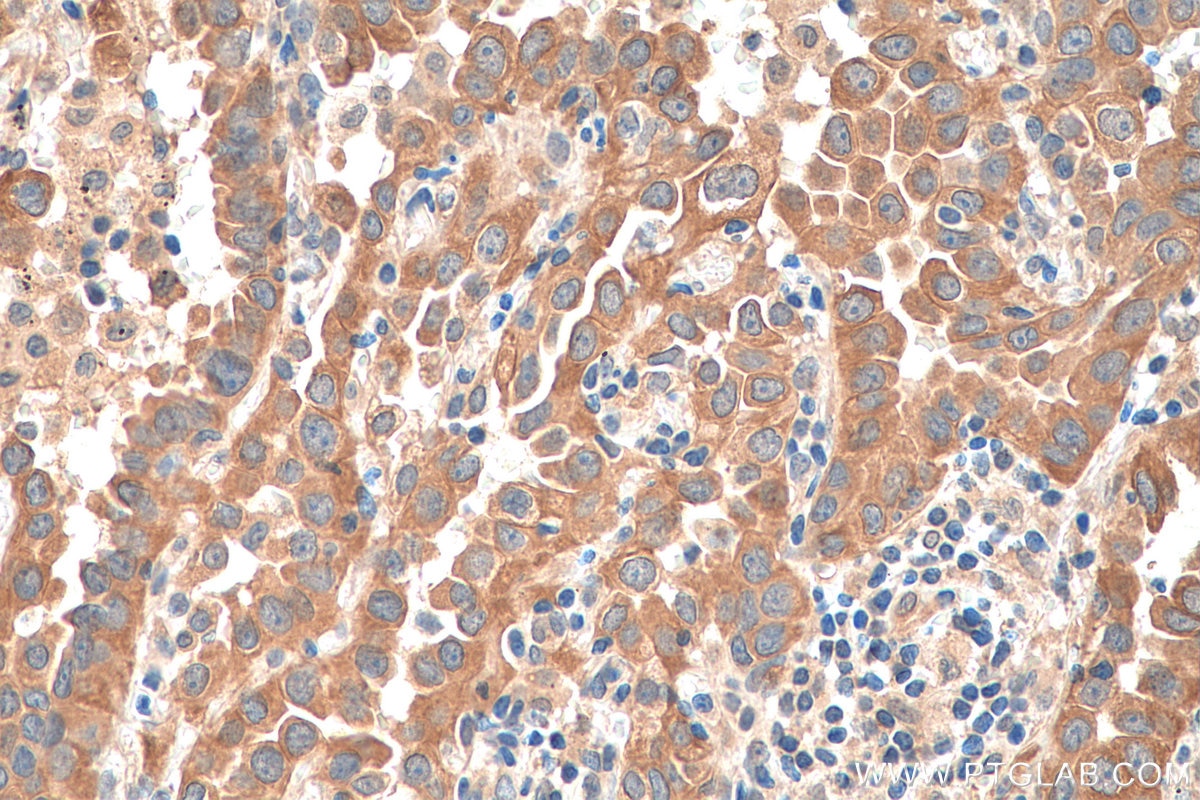 Immunohistochemistry (IHC) staining of human lung cancer tissue using TUBG2 Polyclonal antibody (28009-1-AP)