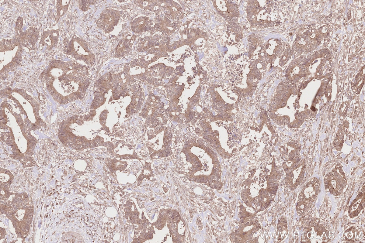 IHC staining of human rectal cancer using 14620-1-AP (same clone as 14620-1-PBS) Immunohistochemistry (IHC) staining of human rectal cancer tissue using TUBGCP5 Polyclonal antibody (14620-1-AP)
