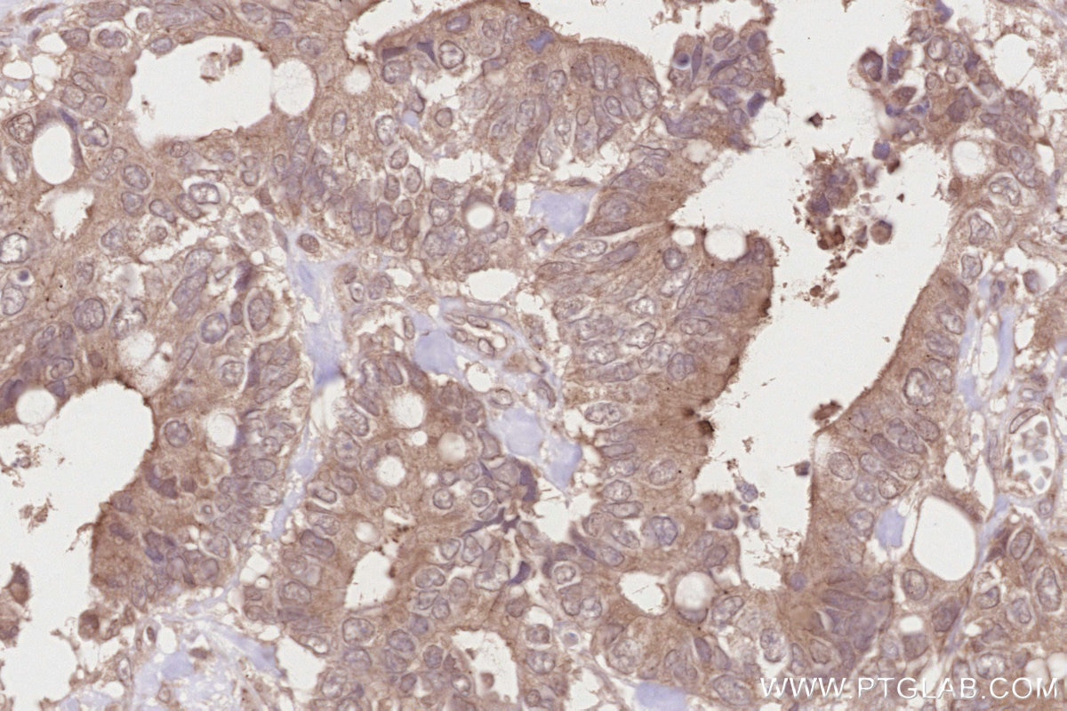 IHC staining of human rectal cancer using 14620-1-AP Immunohistochemistry (IHC) staining of human rectal cancer tissue using TUBGCP5 Polyclonal antibody (14620-1-AP)