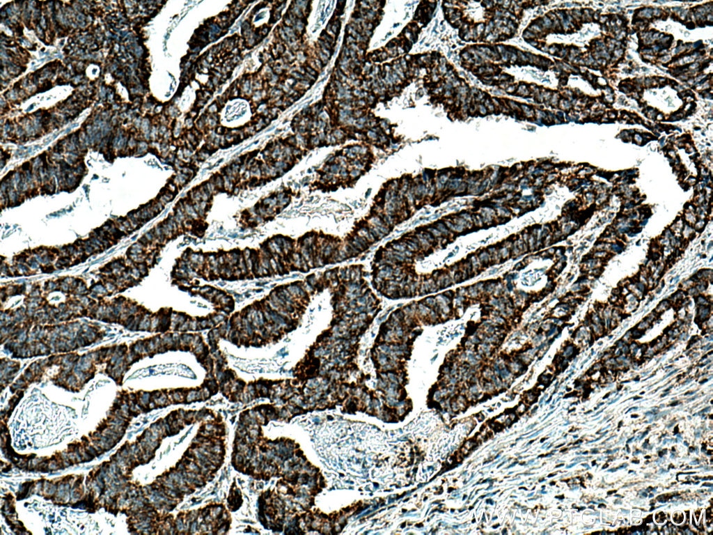 IHC staining of human colon cancer using 67802-1-Ig