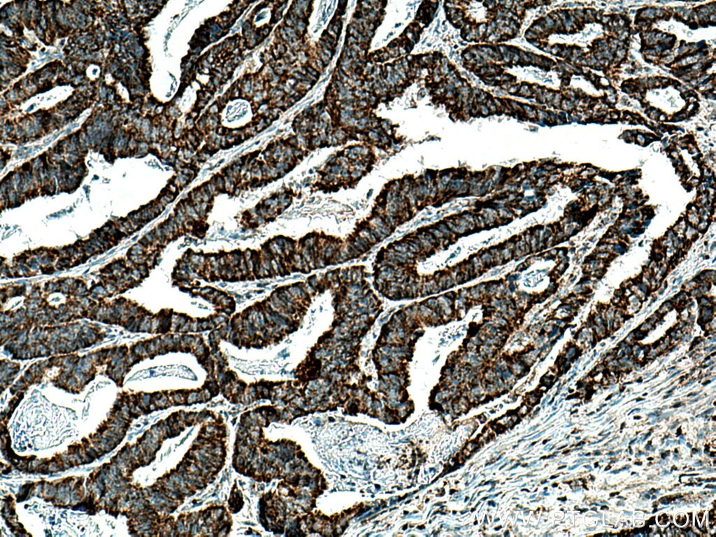 Immunohistochemistry (IHC) staining of human colon cancer tissue using TUFM Monoclonal antibody (67802-1-Ig)