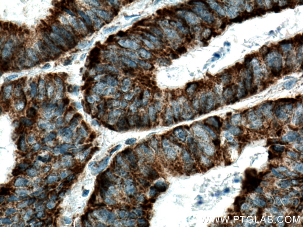 Immunohistochemistry (IHC) staining of human colon cancer tissue using TUFM Monoclonal antibody (67802-1-Ig)