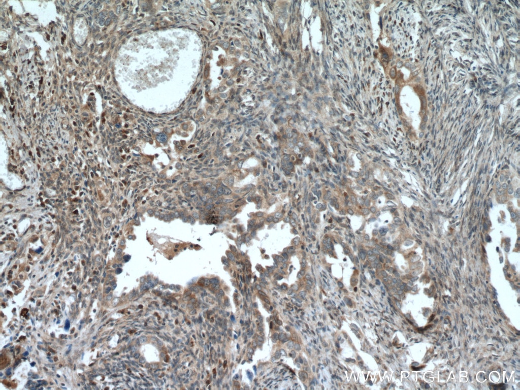Immunohistochemistry (IHC) staining of human ovary tumor tissue using TULP3 Polyclonal antibody (13637-1-AP)