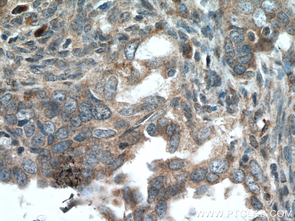 Immunohistochemistry (IHC) staining of human ovary tumor tissue using TULP3 Polyclonal antibody (13637-1-AP)