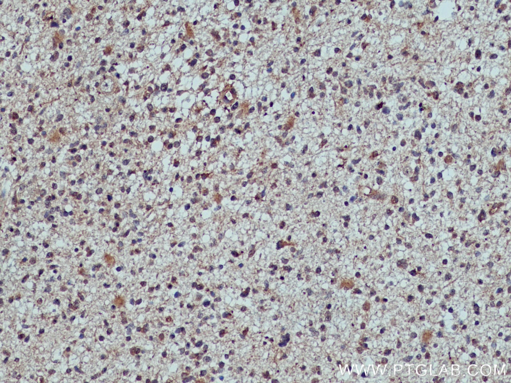 Immunohistochemistry (IHC) staining of human gliomas tissue using TULP3 Polyclonal antibody (13637-1-AP)