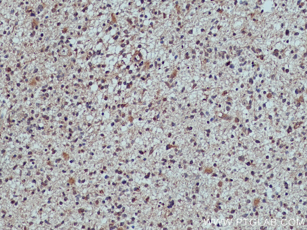 IHC staining of human gliomas using 13637-1-AP