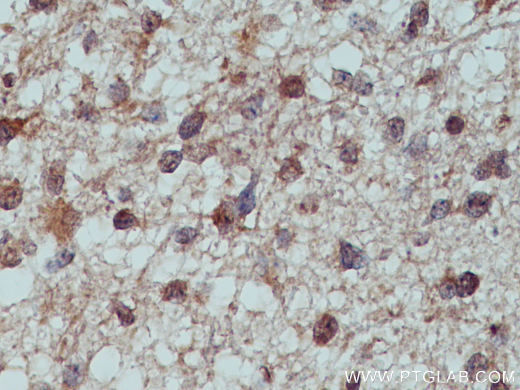 Immunohistochemistry (IHC) staining of human gliomas tissue using TULP3 Polyclonal antibody (13637-1-AP)