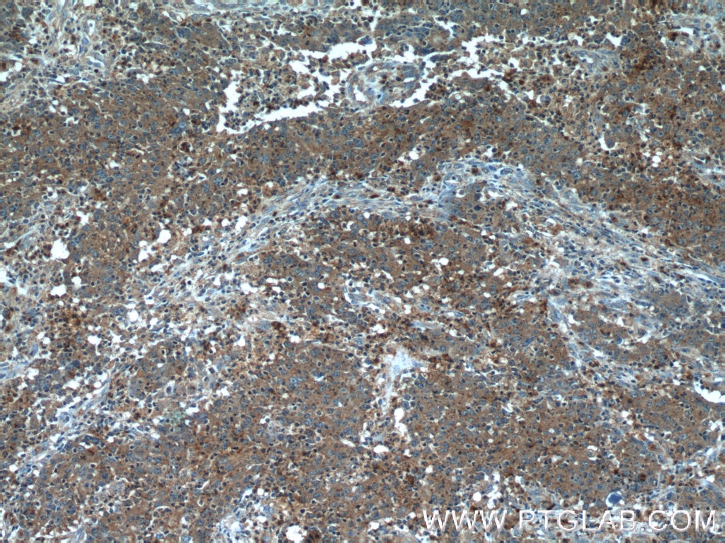 IHC staining of human colon cancer using 11538-1-AP