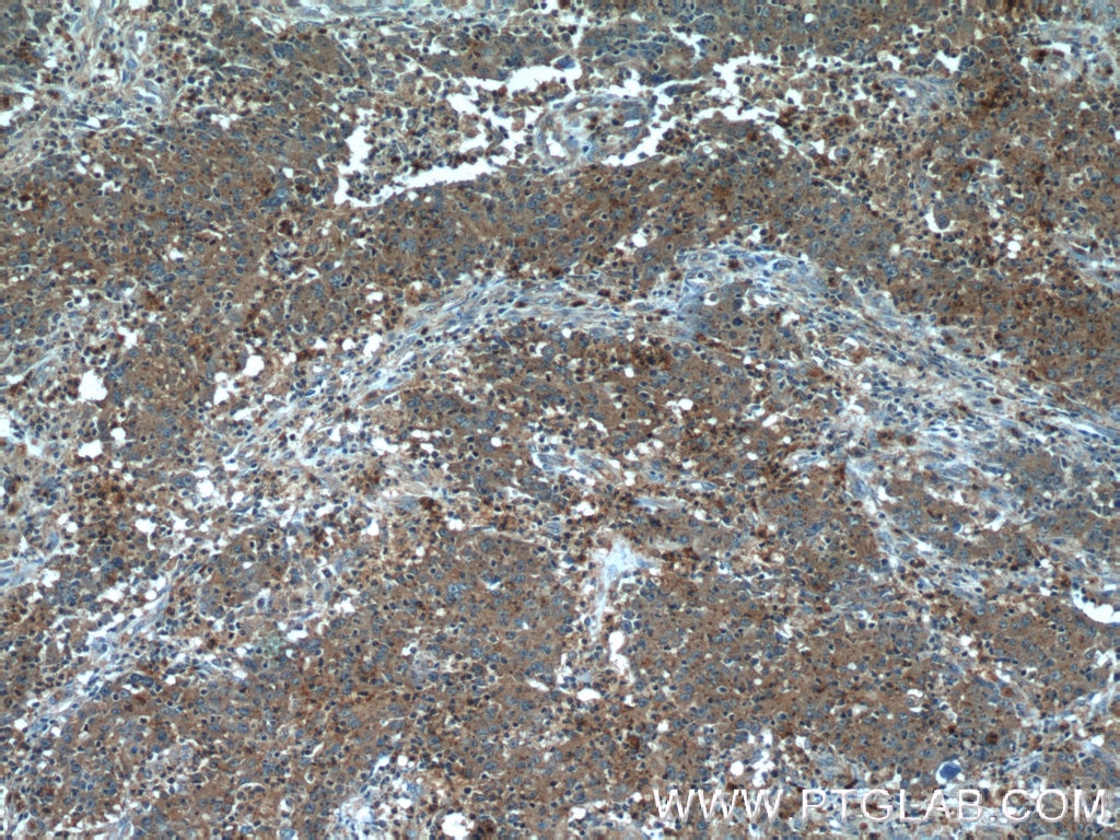 Immunohistochemistry (IHC) staining of human colon cancer tissue using TUSC2 Polyclonal antibody (11538-1-AP)