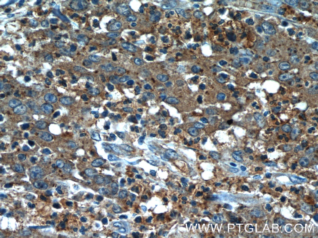 Immunohistochemistry (IHC) staining of human colon cancer tissue using TUSC2 Polyclonal antibody (11538-1-AP)