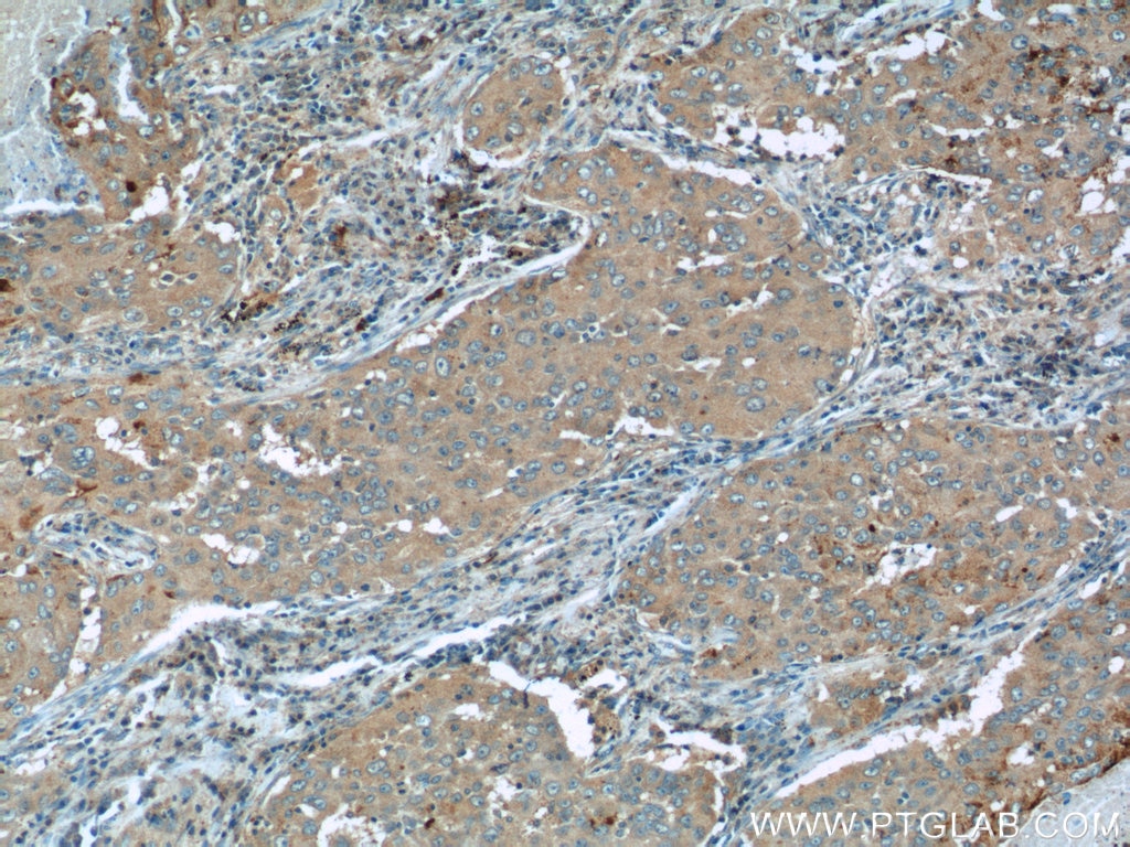 Immunohistochemistry (IHC) staining of human lung cancer tissue using TUSC2 Polyclonal antibody (11538-1-AP)