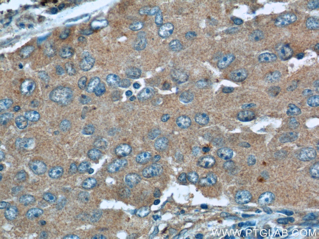 Immunohistochemistry (IHC) staining of human lung cancer tissue using TUSC2 Polyclonal antibody (11538-1-AP)