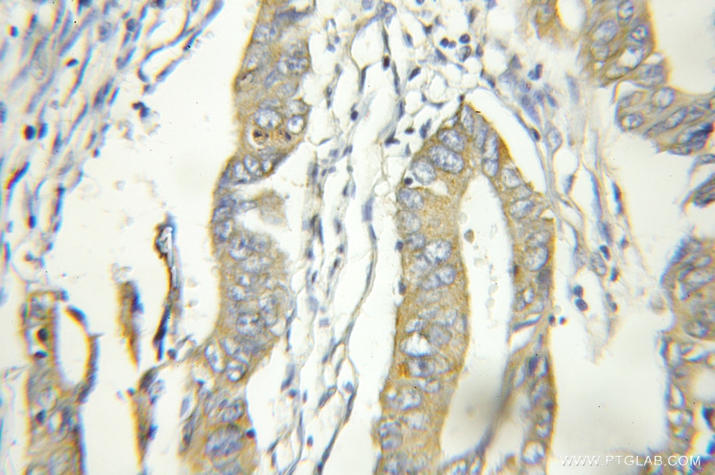 Immunohistochemistry (IHC) staining of human colon cancer tissue using TUSC2 Polyclonal antibody (11538-1-AP)