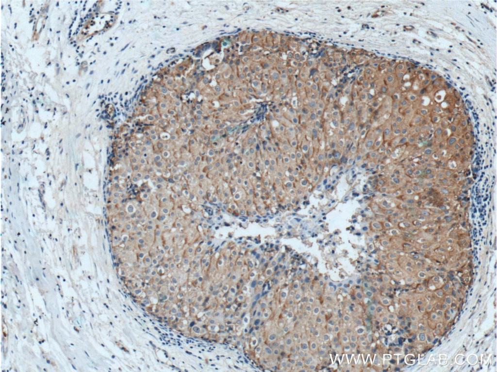 Immunohistochemistry (IHC) staining of human breast cancer tissue using TUSC5 Polyclonal antibody (21556-1-AP)