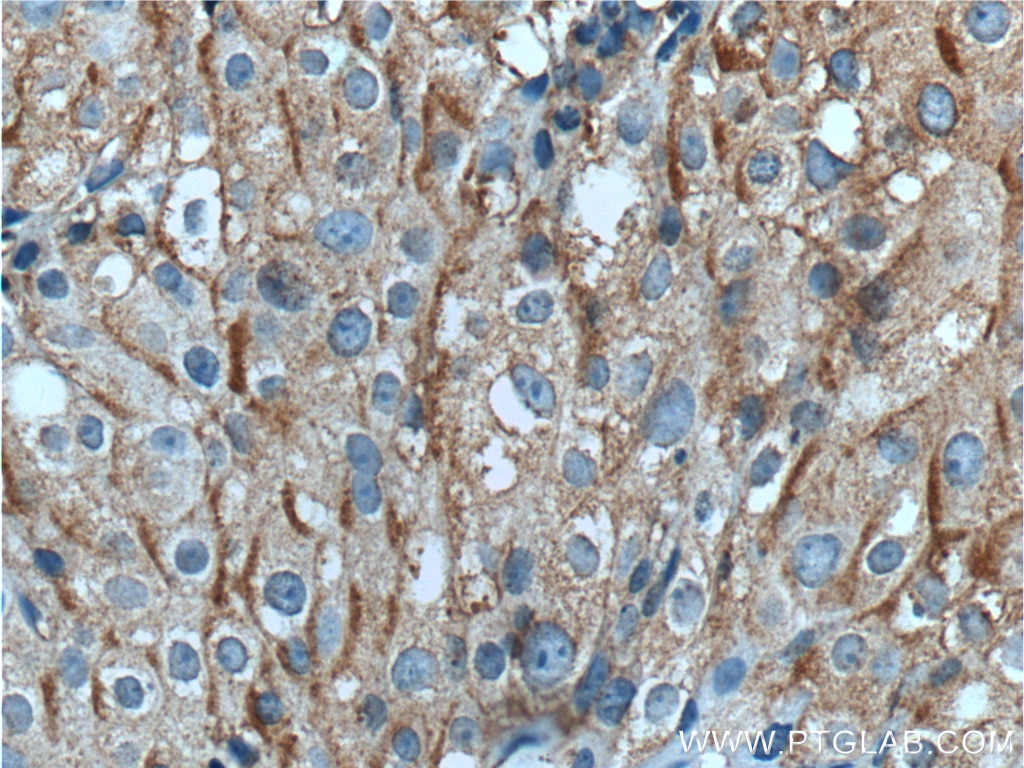 Immunohistochemistry (IHC) staining of human breast cancer tissue using TUSC5 Polyclonal antibody (21556-1-AP)