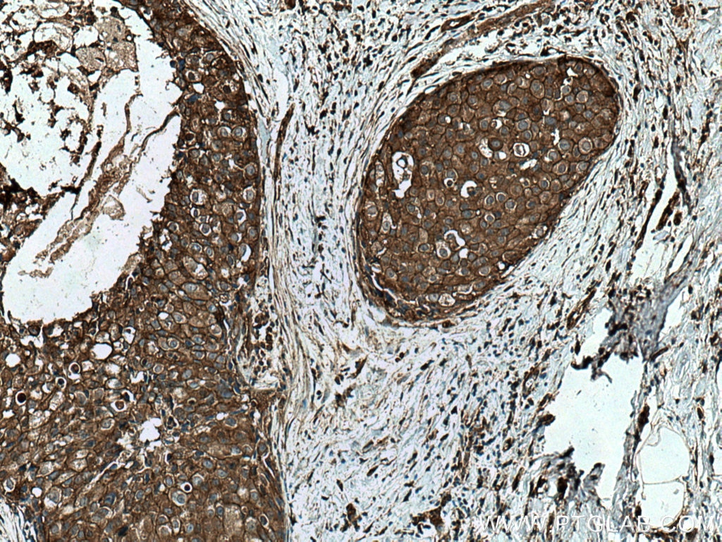 Immunohistochemistry (IHC) staining of human breast cancer tissue using TWF1 Polyclonal antibody (11732-1-AP)