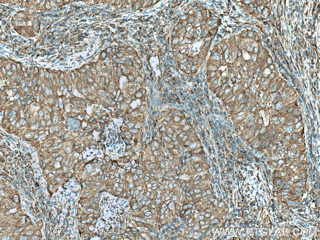 Immunohistochemistry (IHC) staining of human lung cancer tissue using TWF1 Polyclonal antibody (11732-1-AP)