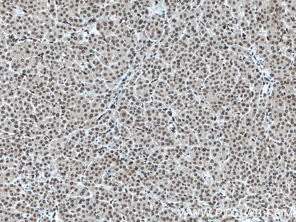 Immunohistochemistry (IHC) staining of human liver cancer tissue using TWIST1-specific Polyclonal antibody (25465-1-AP)