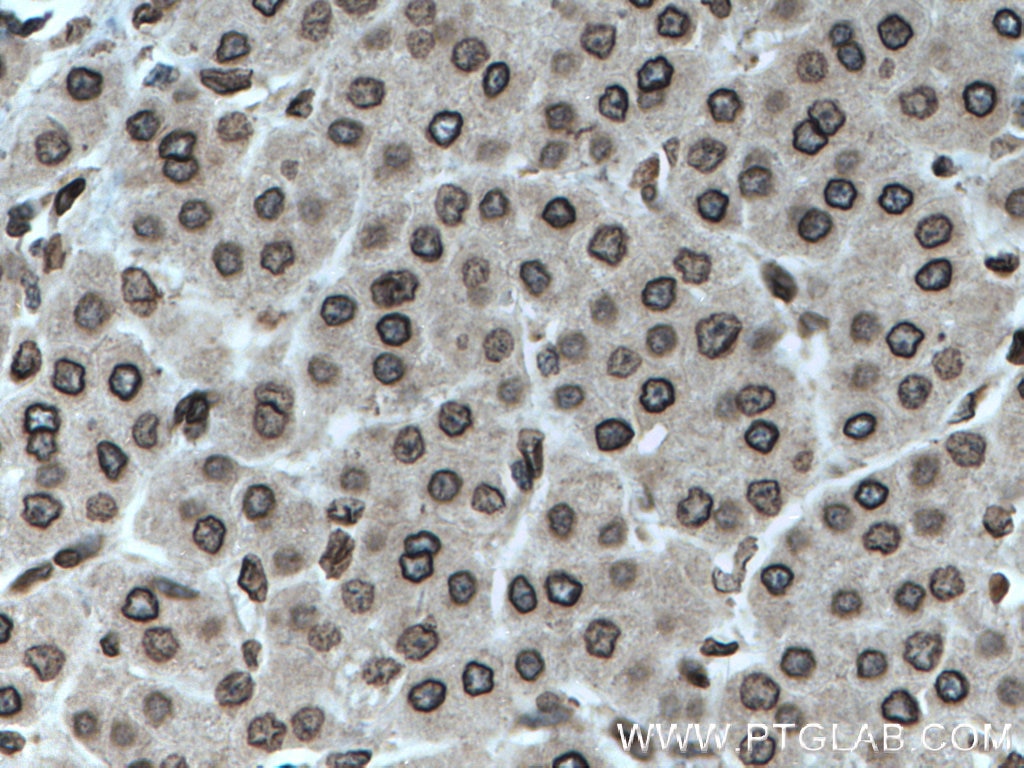 Immunohistochemistry (IHC) staining of human liver cancer tissue using TWIST1-specific Polyclonal antibody (25465-1-AP)