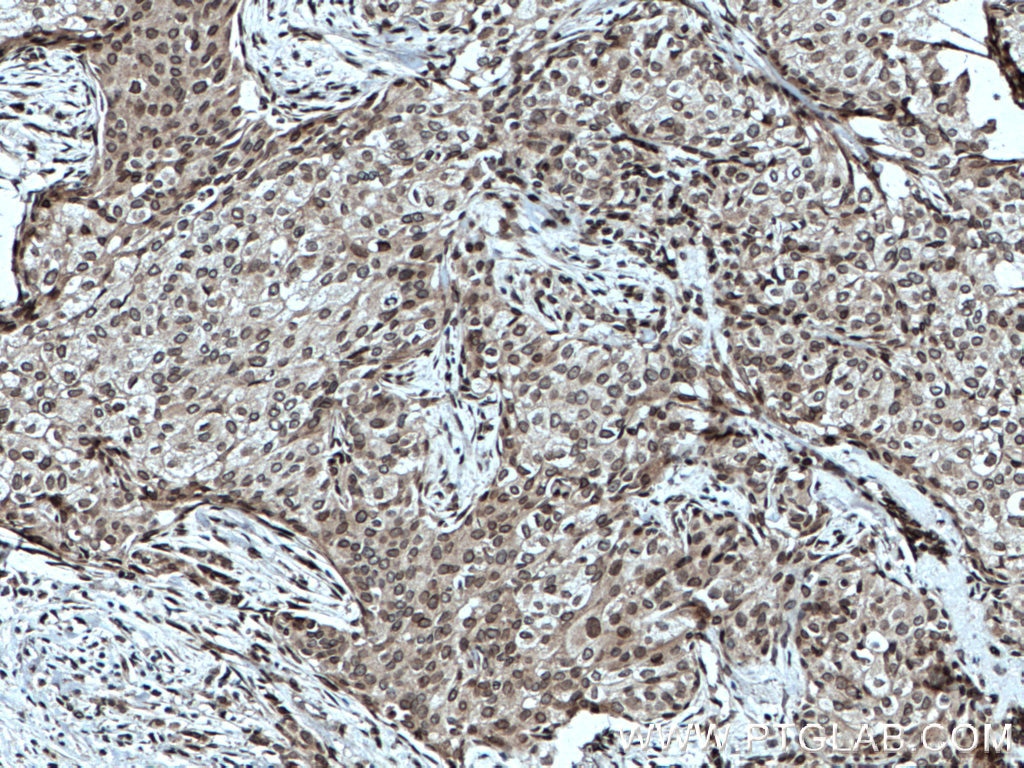 Immunohistochemistry (IHC) staining of human breast cancer tissue using TWIST1-specific Polyclonal antibody (25465-1-AP)