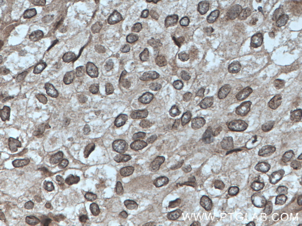 Immunohistochemistry (IHC) staining of human breast cancer tissue using TWIST1-specific Polyclonal antibody (25465-1-AP)