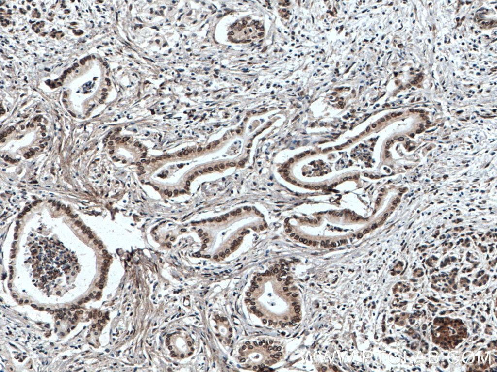 Immunohistochemistry (IHC) staining of human pancreas cancer tissue using TWIST1-specific Polyclonal antibody (25465-1-AP)
