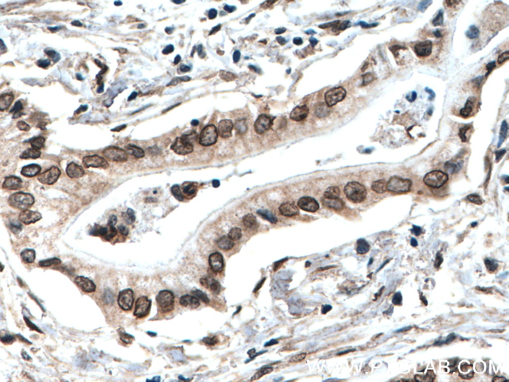 Immunohistochemistry (IHC) staining of human pancreas cancer tissue using TWIST1-specific Polyclonal antibody (25465-1-AP)