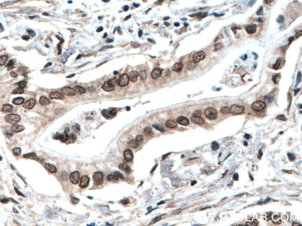 IHC staining of human pancreas cancer using 25465-1-AP