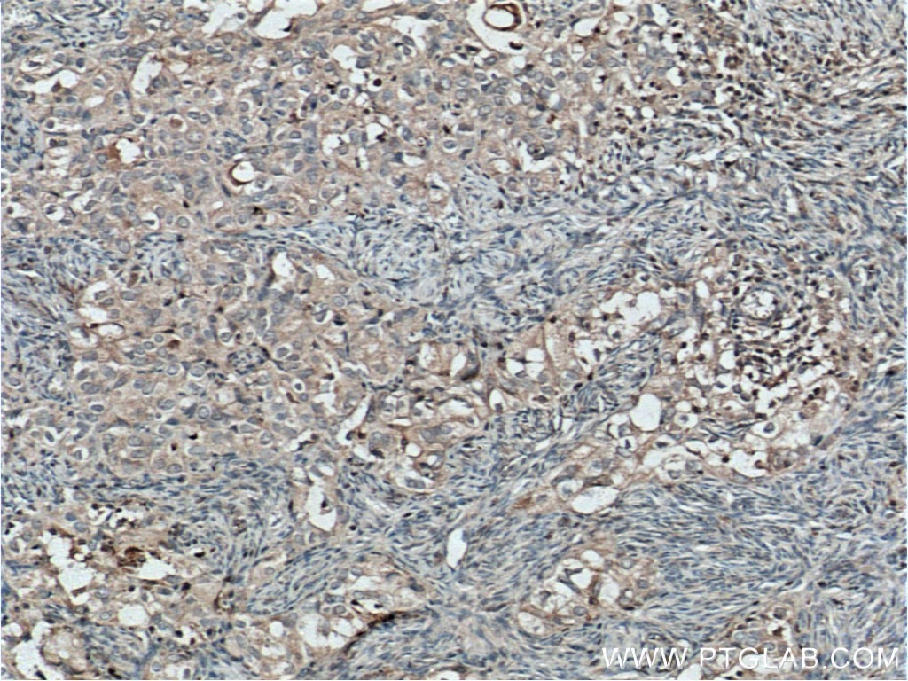 Immunohistochemistry (IHC) staining of human ovary tumor tissue using TWIST2 Monoclonal antibody (66544-1-Ig)