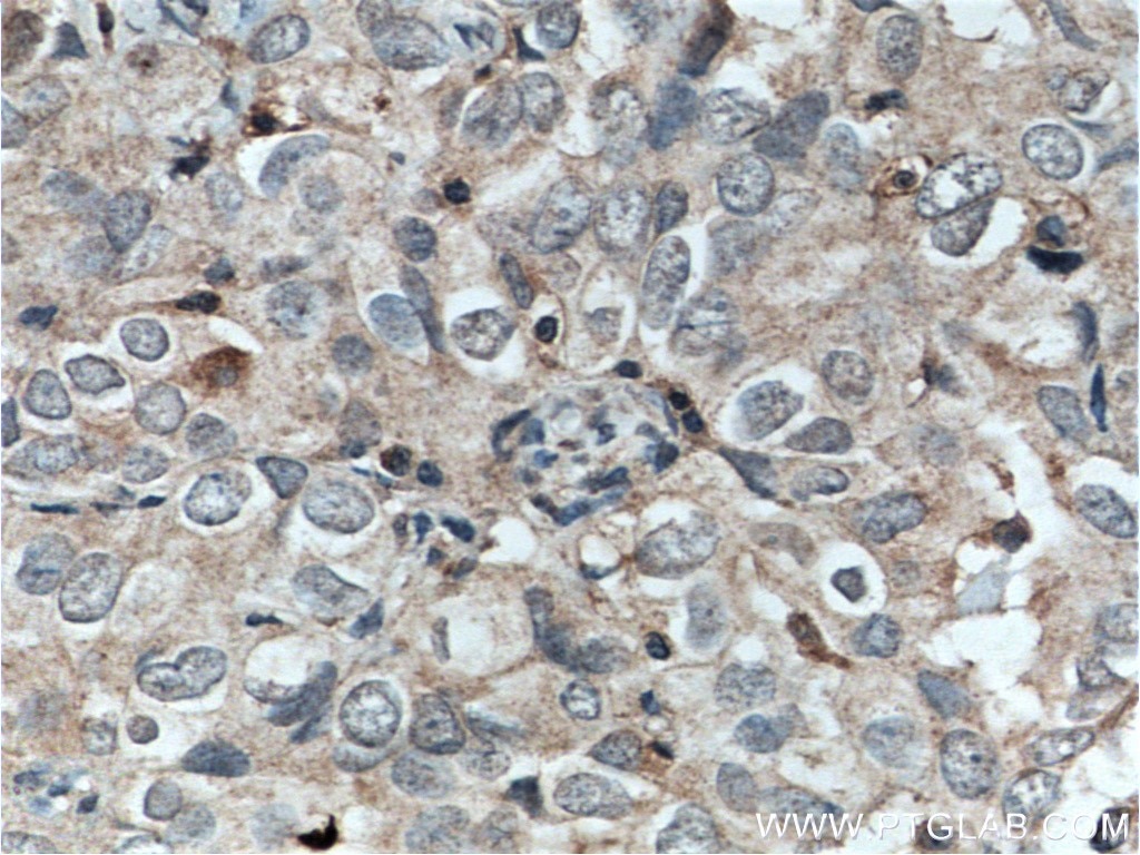 Immunohistochemistry (IHC) staining of human ovary tumor tissue using TWIST2 Monoclonal antibody (66544-1-Ig)