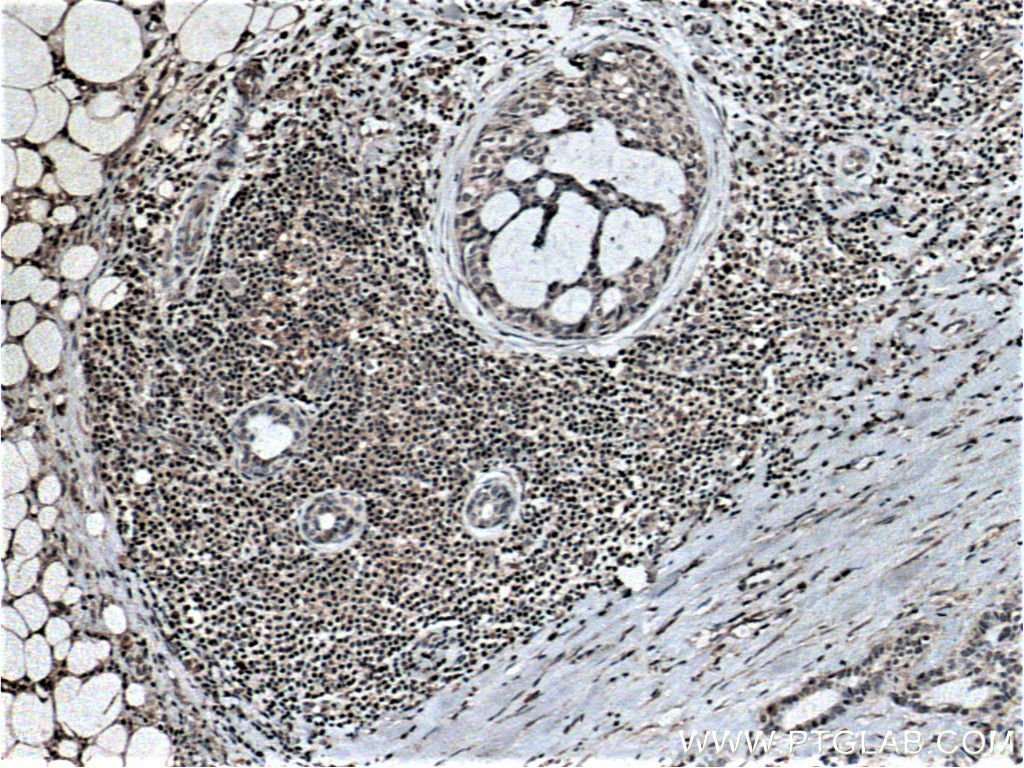 Immunohistochemistry (IHC) staining of human breast cancer tissue using TWIST2 Monoclonal antibody (66544-1-Ig)