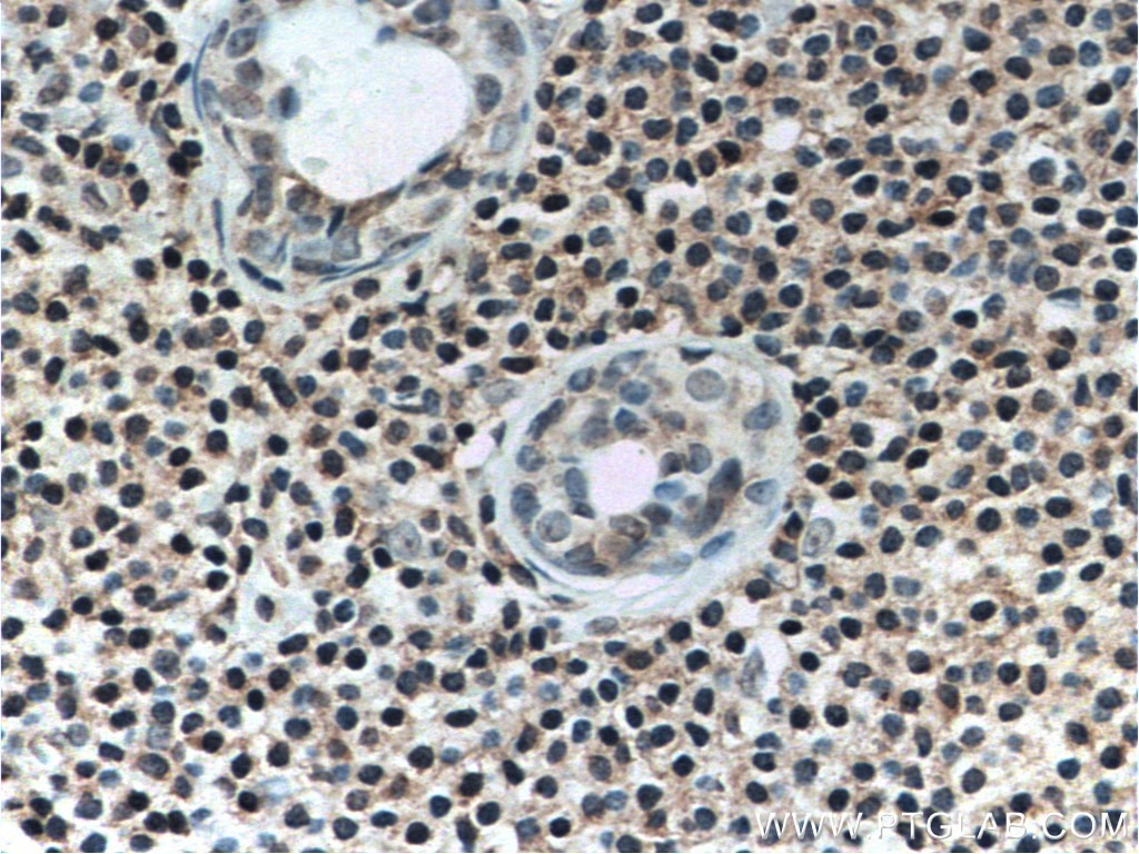 Immunohistochemistry (IHC) staining of human breast cancer tissue using TWIST2 Monoclonal antibody (66544-1-Ig)