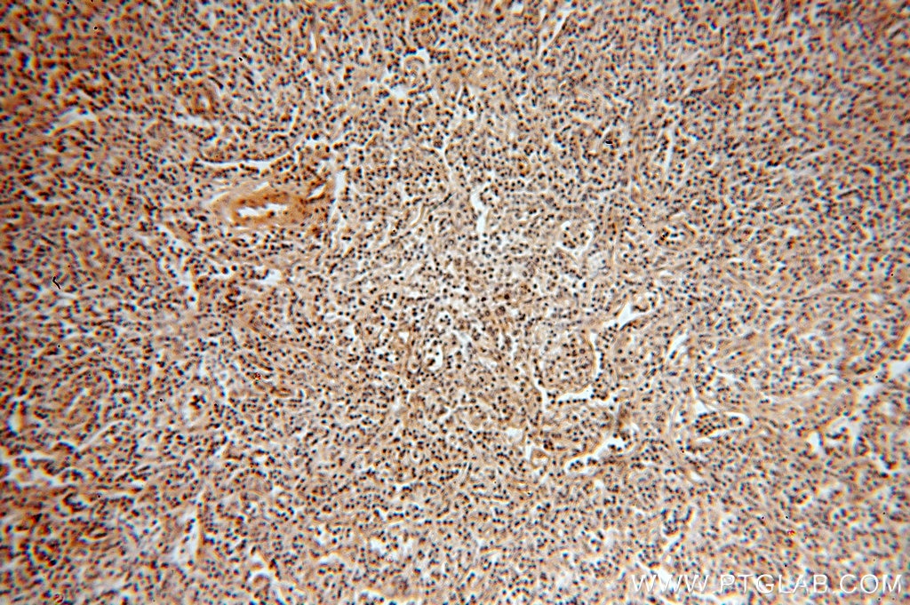Immunohistochemistry (IHC) staining of human lymphoma tissue using TXK Polyclonal antibody (18981-1-AP)