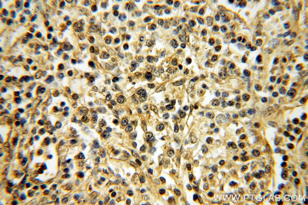 Immunohistochemistry (IHC) staining of human lymphoma tissue using TXK Polyclonal antibody (18981-1-AP)