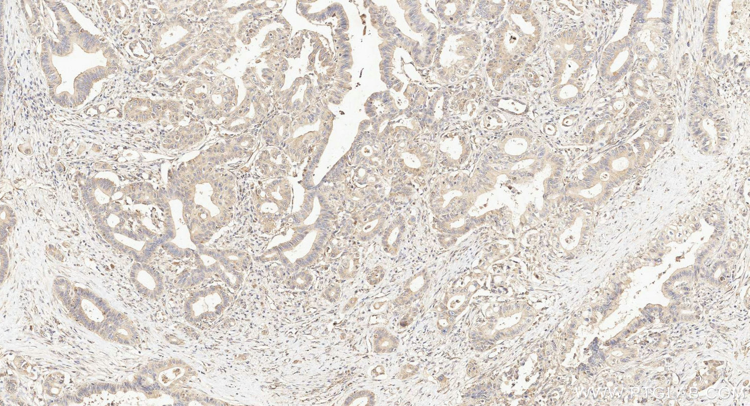 IHC staining of human pancreas cancer using 27558-1-AP Immunohistochemistry (IHC) staining of human pancreas cancer tissue using Alpha Taxilin Polyclonal antibody (27558-1-AP)