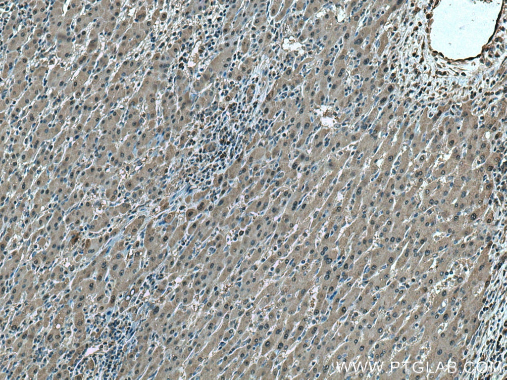 Immunohistochemistry (IHC) staining of human liver cancer tissue using Thioredoxin Polyclonal antibody (14999-1-AP)