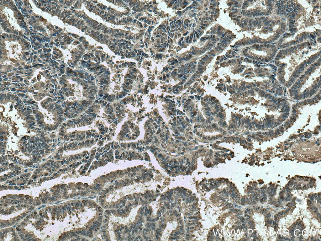 Immunohistochemistry (IHC) staining of human ovary tumor tissue using Thioredoxin Polyclonal antibody (14999-1-AP)