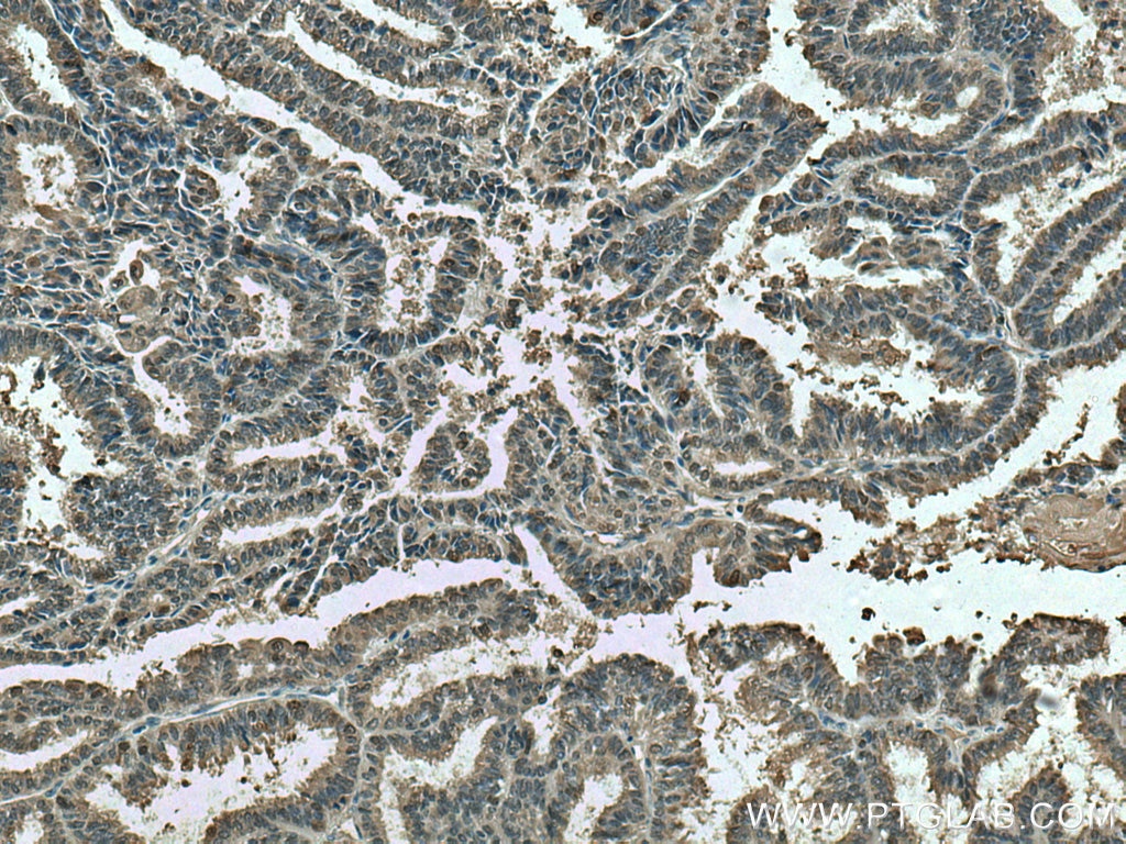 IHC staining of human ovary tumor using 14999-1-AP