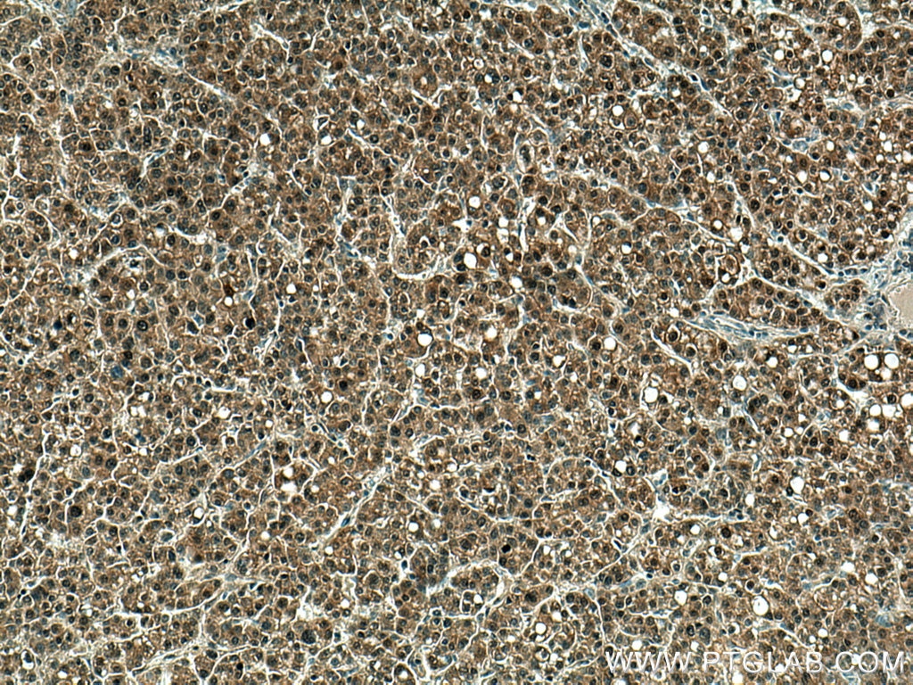 IHC staining of human liver cancer using 66475-1-Ig
