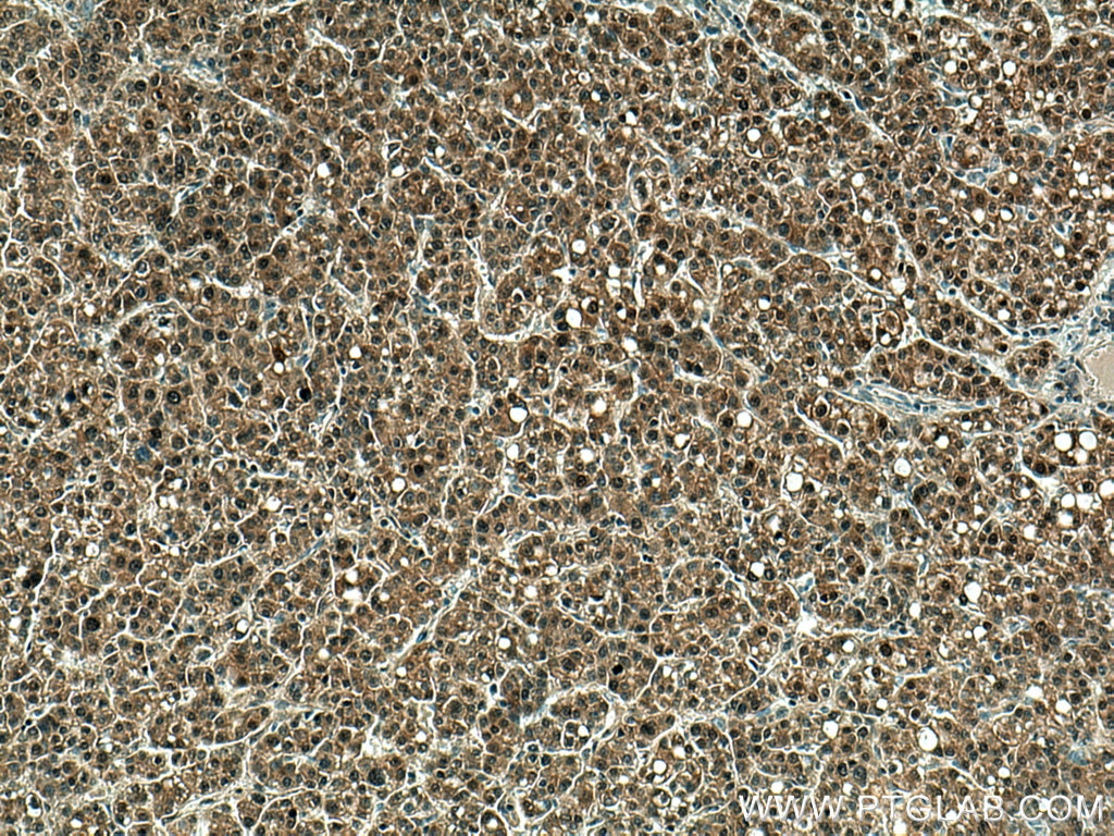 Immunohistochemistry (IHC) staining of human liver cancer tissue using Thioredoxin Monoclonal antibody (66475-1-Ig)