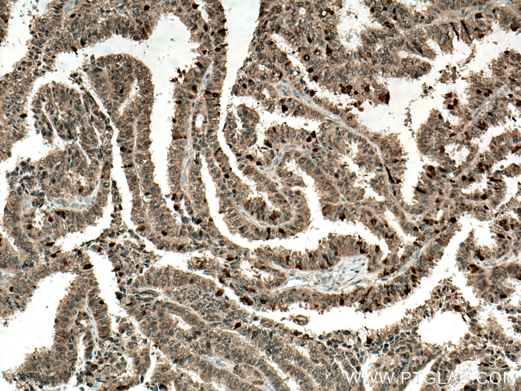 Immunohistochemistry (IHC) staining of human ovary tumor tissue using Thioredoxin Monoclonal antibody (66475-1-Ig)