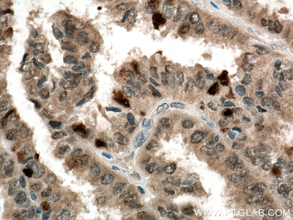 Immunohistochemistry (IHC) staining of human ovary tumor tissue using Thioredoxin Monoclonal antibody (66475-1-Ig)